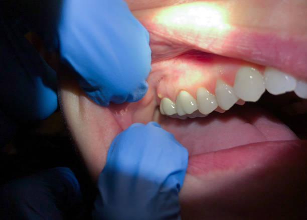 Urgent Tooth Repair in IA